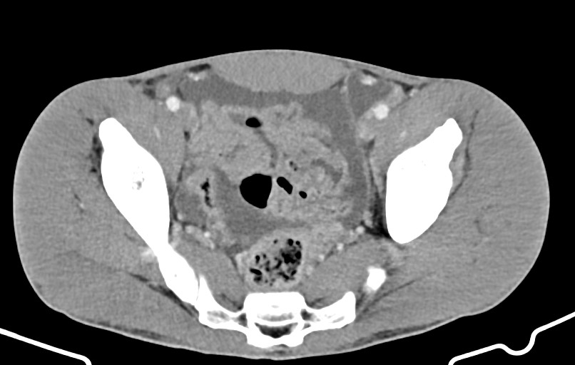 Blunt injury to the small bowel (Radiopaedia 74953-85987 A 166).jpg