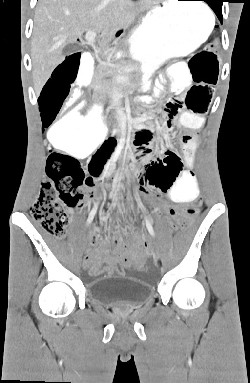 Blunt injury to the small bowel (Radiopaedia 74953-85987 B 41).jpg