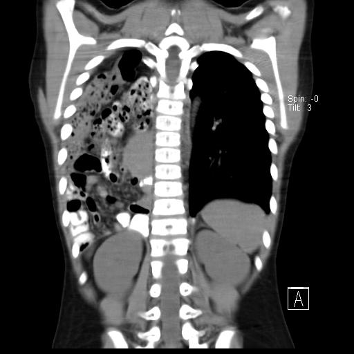 File:Bochdalek diaphragmatic hernia (Radiopaedia 38866-41059 Coronal liver window 16).jpg