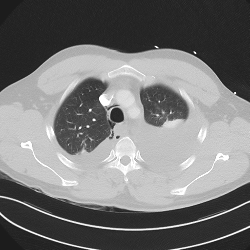 Boerhaave syndrome (Radiopaedia 39382-41660 Axial lung window 14).png