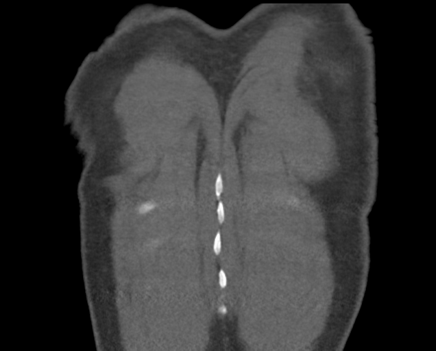 Boerhaave syndrome (Radiopaedia 39382-41660 C 86).png