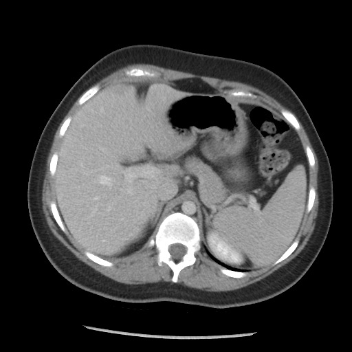File:Borderline mucinous tumor (ovary) (Radiopaedia 78228-90808 A 73).jpg
