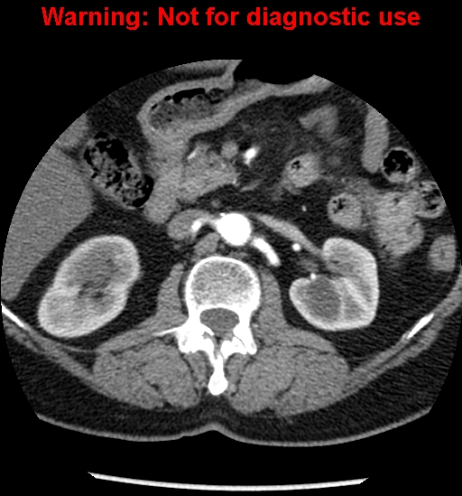 File:Bosniak renal cyst - type II (Radiopaedia 23404-23468 B 21).jpg