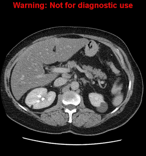 File:Bosniak renal cyst - type II (Radiopaedia 23404-23468 F 19).jpg