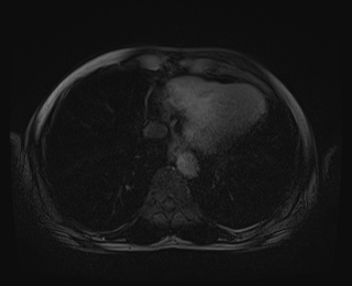 File:Bouveret syndrome (Radiopaedia 61017-68856 Axial T1 C+ fat sat 1).jpg