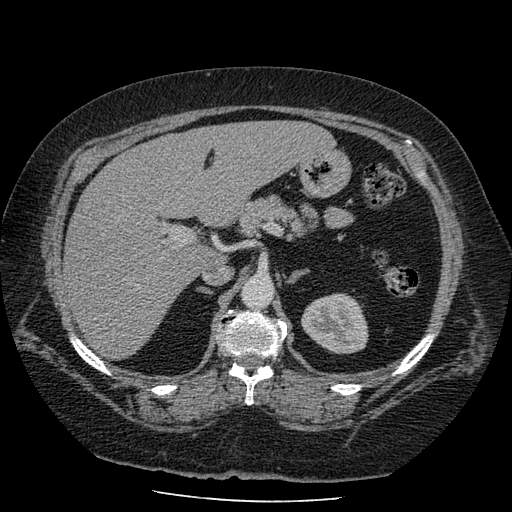 Bovine aortic arch - right internal mammary vein drains into the superior vena cava (Radiopaedia 63296-71875 A 187).jpg