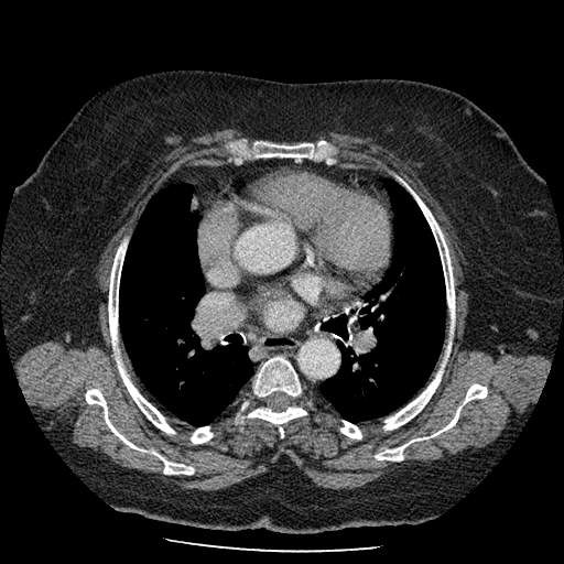 Bovine aortic arch - right internal mammary vein drains into the superior vena cava (Radiopaedia 63296-71875 A 74).jpg