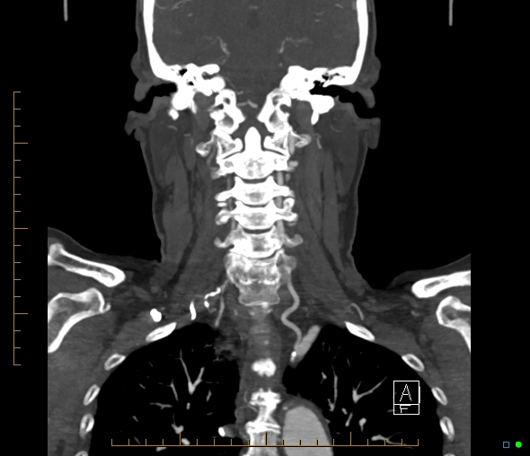 Brachiocephalic trunk stenosis (Radiopaedia 87242-103519 B 44).jpg