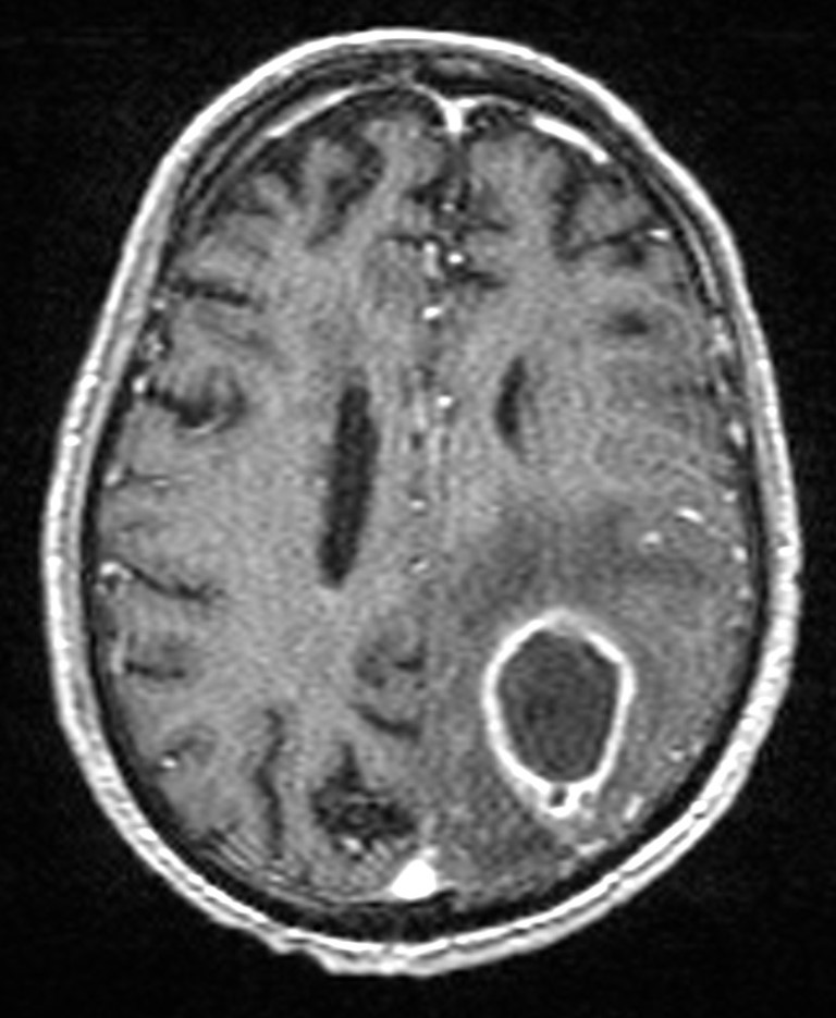 Brain abscess with dual rim sign (Radiopaedia 87566-103938 Axial T1 C+ 110).jpg