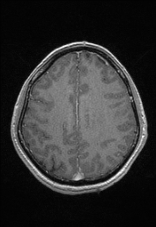 Brain abscess with ventriculitis (Radiopaedia 85703-101495 Axial T1 C+ 125).jpg