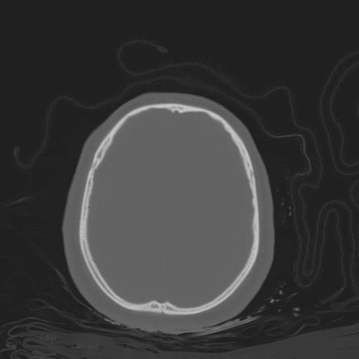 File:Brain contusions, internal carotid artery dissection and base of skull fracture (Radiopaedia 34089-35339 Axial bone window 96).png