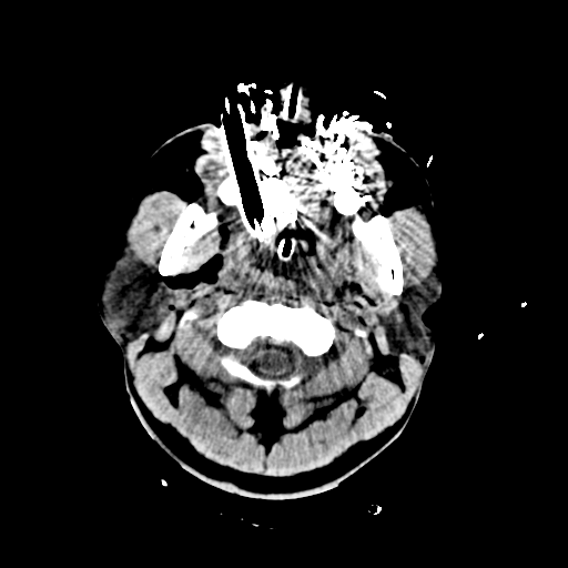 File:Brain contusions, internal carotid artery dissection and base of skull fracture (Radiopaedia 34089-35339 Axial non-contrast 11).png