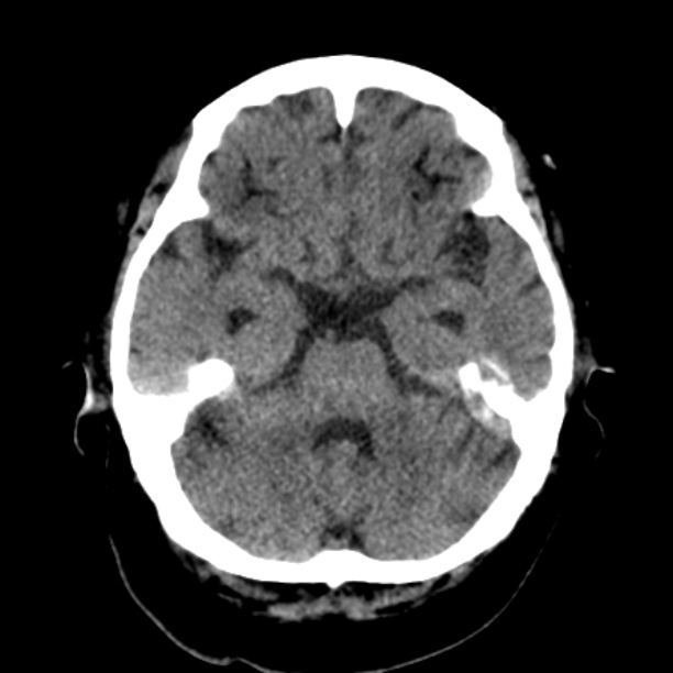 Brain cortical laminar necrosis (Radiopaedia 25822-25971 Axial non-contrast 13).jpg