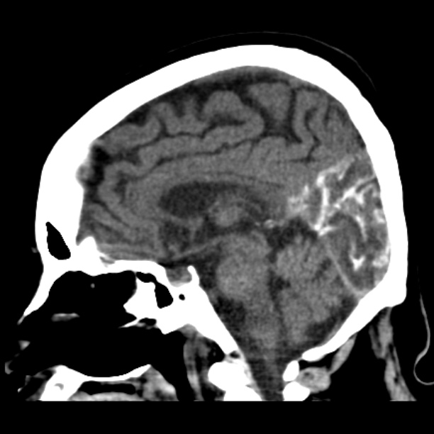 Brain cortical laminar necrosis (Radiopaedia 25822-25971 non-contrast 27).jpg