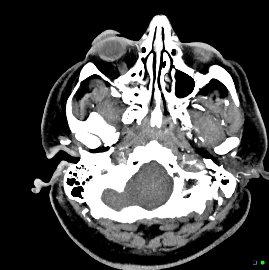 File:Brain death on MRI and CT angiography (Radiopaedia 42560-45841 B 45).jpg