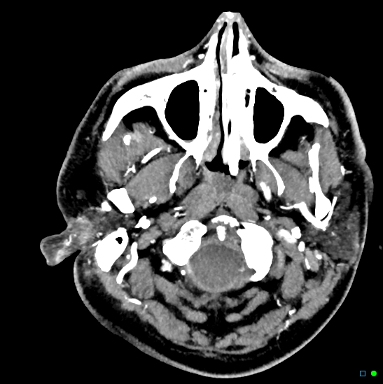 Brain death on MRI and CT angiography (Radiopaedia 42560-45841 B 49).jpg