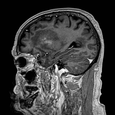 Brain metastases from lung cancer (Radiopaedia 83839-99028 Sagittal T1 C+ 18).jpg