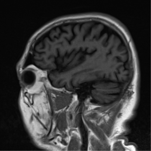 File:Brain metastasis (large cystic mass) (Radiopaedia 47497-52107 Sagittal T1 22).png