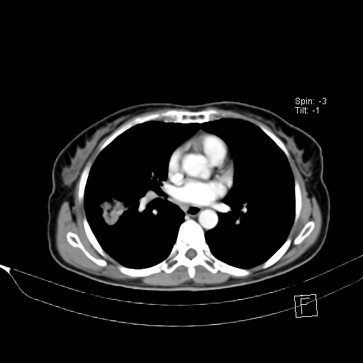 Brain metastasis as initial presentation of non-small cell lung cancer (Radiopaedia 65122-74127 A 26).jpg