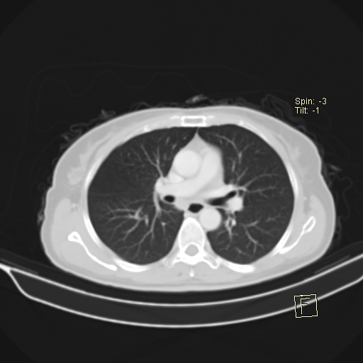 Brain metastasis as initial presentation of non-small cell lung cancer (Radiopaedia 65122-74127 Axial lung window 22).jpg