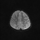 Brainstem glioma (Radiopaedia 67531-76922 Axial DWI 19).jpg
