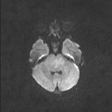 Brainstem glioma (Radiopaedia 67531-76922 Axial DWI 54).jpg