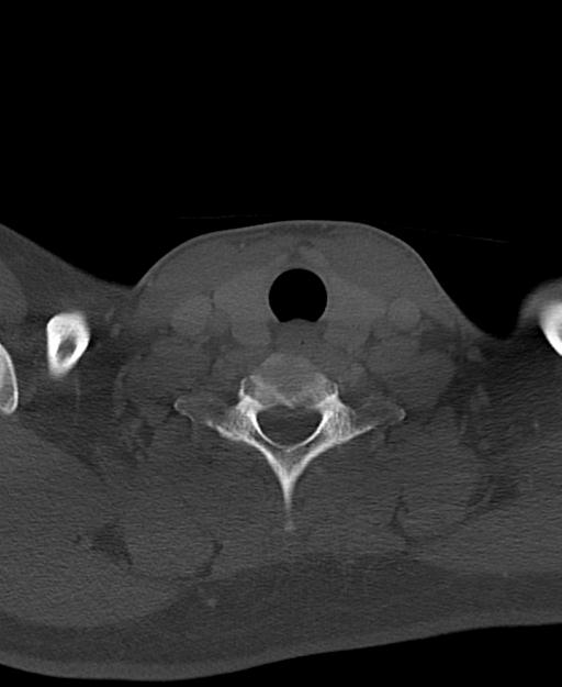 Branchial cleft cyst (Radiopaedia 31167-31875 Axial bone window 58).jpg