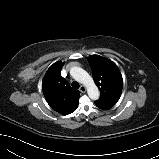 File:Breast carcinoma with pathological hip fracture (Radiopaedia 60314-67974 A 17).jpg