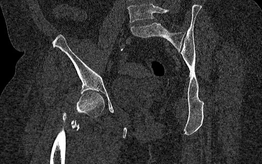 Breast carcinoma with pathological hip fracture (Radiopaedia 60314-67993 Coronal bone window 73).jpg