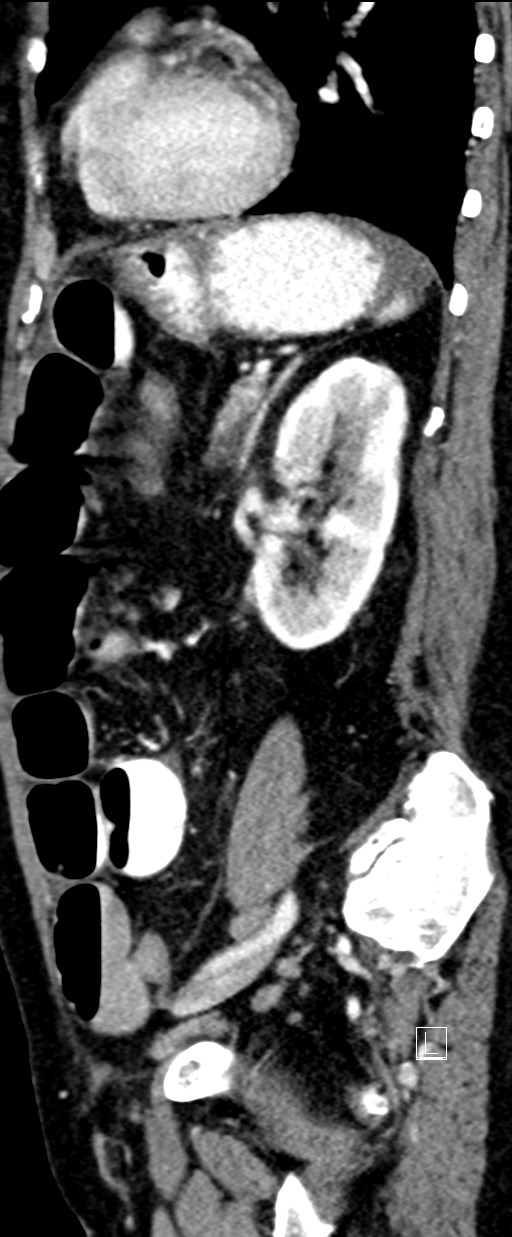 Broad ligament hernia (Radiopaedia 84802-100276 C 22).jpg