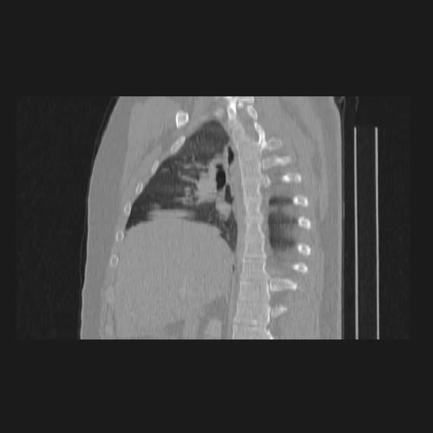 Bronchial atresia (Radiopaedia 60685-68439 Sagittal lung window 36).jpg