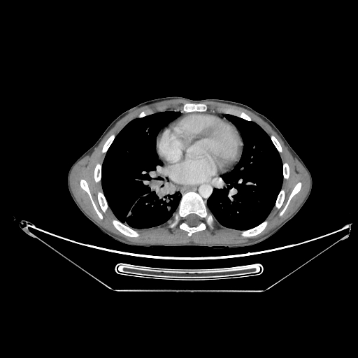 Bronchial carcinoid tumor (Radiopaedia 57187-64090 A 46).jpg