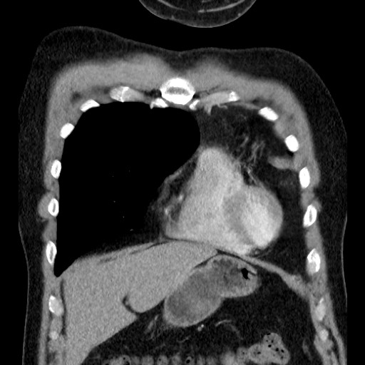Bronchial carcinoid tumor (Radiopaedia 67377-76764 C 22).jpg