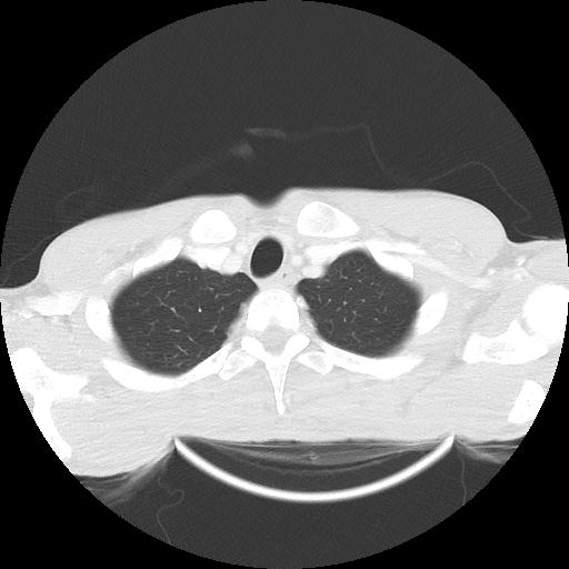 Bronchial carcinoid tumor causing right lower lobe collapse (Radiopaedia 83495-98594 Axial lung window 3).jpg