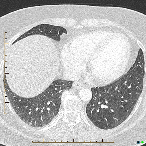 Bronchial diverticula (Radiopaedia 79512-92676 Axial lung window 151).jpg