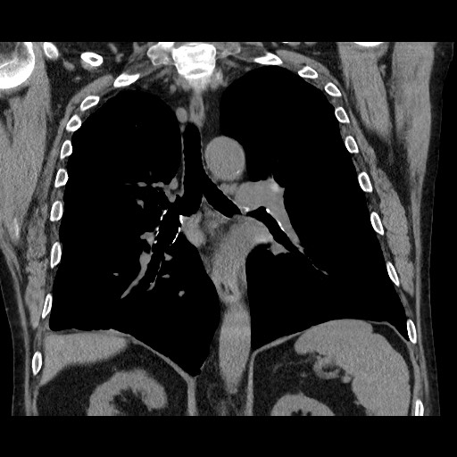 File:Bronchial stenosis - lung transplant (Radiopaedia 73133-83848 Coronal non-contrast 40).jpg