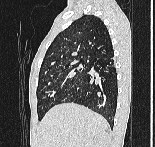 Bronchiolitis obliterans (Radiopaedia 71538-81897 Sagittal lung window 18).jpg