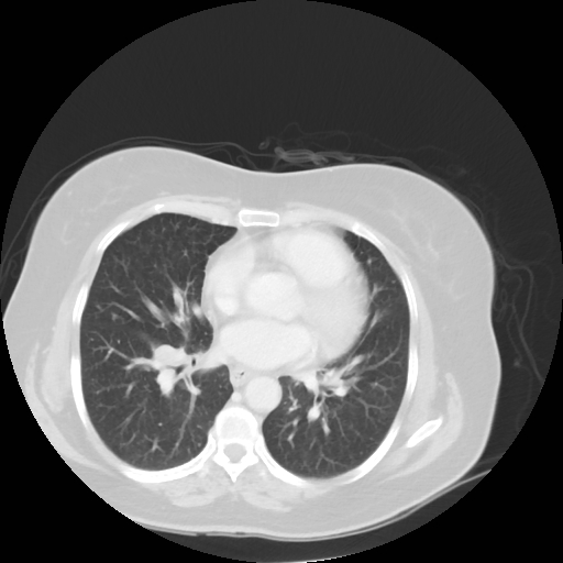 Bronchogenic carcinoma (Radiopaedia 73497-84262 Axial lung window 39).jpg