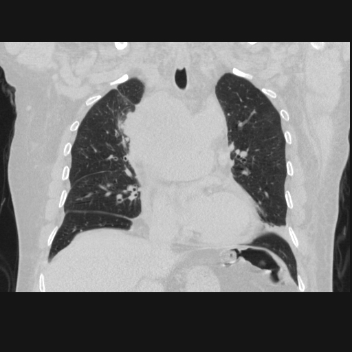 File:Bronchogenic carcinoma with metastatic lymphadenopathy (Radiopaedia 37671-39569 Coronal lung window 21).jpg
