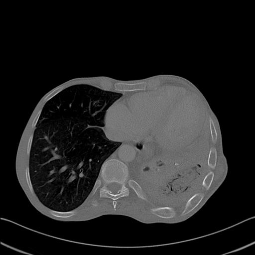 File:Bronchopleural fistula secondary to tuberculosis (Radiopaedia 20415-20322 Axial bone window 22).jpg