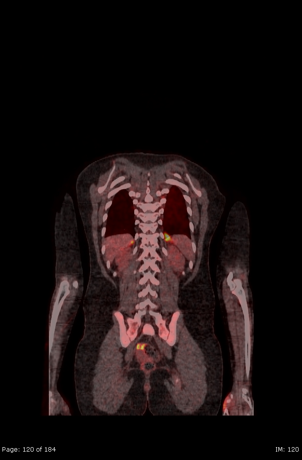 Brown fat uptake (FDG PET-CT) (Radiopaedia 77392-89513 Fused coronal 78).jpg
