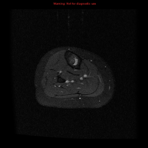 File:Brown tumor (Radiopaedia 12318-12597 Axial T1 C+ fat sat 29).jpg