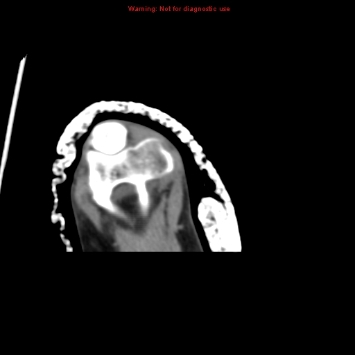File:Brown tumor (Radiopaedia 12460-12694 Axial non-contrast 137).jpg