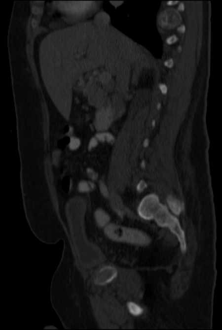 Brown tumors compressing the spinal cord (Radiopaedia 68442-77988 H 24).jpg