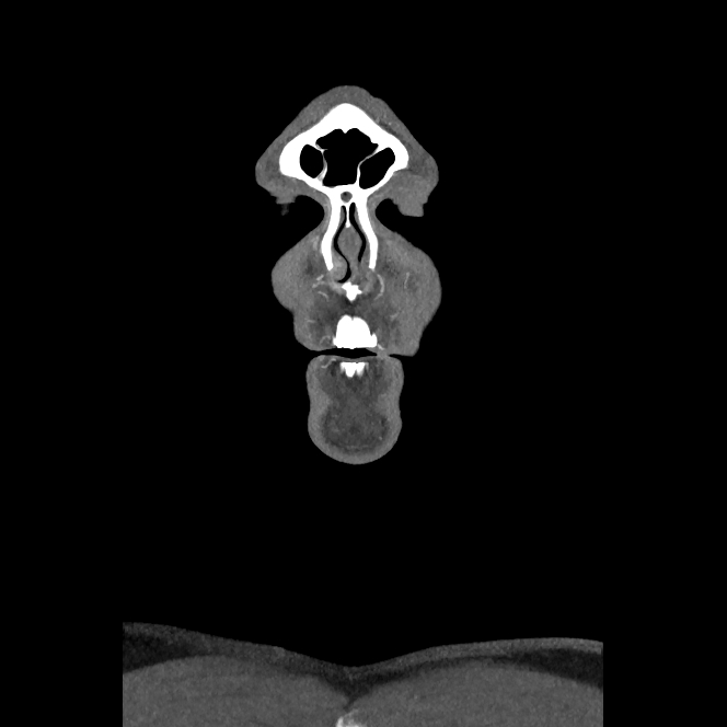 Buccal fat pad arteriovenous malformation (Radiopaedia 70936-81144 B 3).jpg
