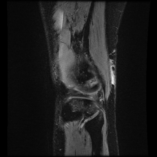 File:Bucket handle meniscus tear (Radiopaedia 56916-63751 H 7).jpg