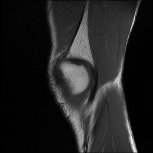 File:Bucket handle tear - medial meniscus (Radiopaedia 69245-79026 Sagittal T1 17).jpg
