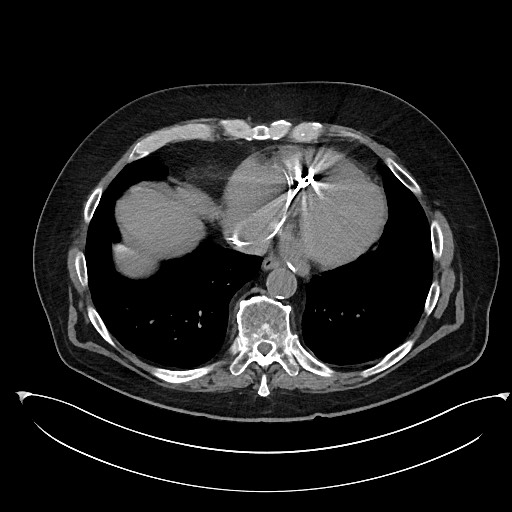 File:Buried bumper syndrome - gastrostomy tube (Radiopaedia 63843-72577 Axial Inject 4).jpg
