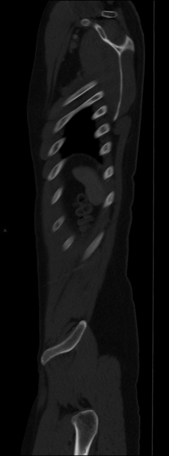 Burst fracture (Radiopaedia 83168-97542 Sagittal bone window 108).jpg