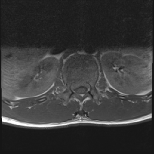 File:Burst fracture - T12 with conus compression (Radiopaedia 56825-63646 Axial T1 15).png
